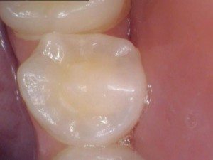 A Beautiful Tooth A beautiful tooth before sealants.