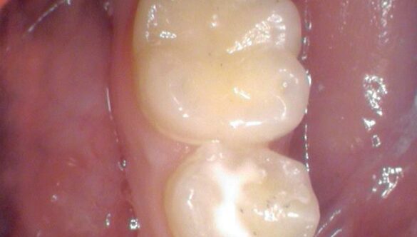 Sealants – An ounce of prevention is . . .