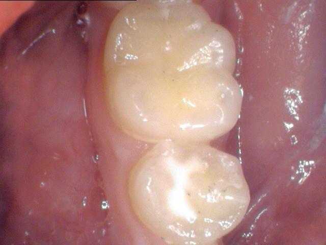 Sealants – An ounce of prevention is . . .