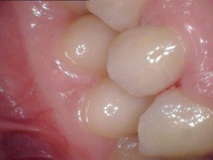 EMAX after #1 This is an "after" photo showing how beautiful a restored tooth looks like with e.max.