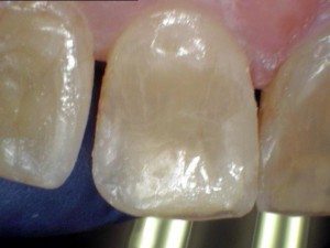 Herculite After After photo - Tooth #9 with a Herculite filling.