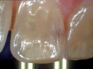 Herculite Before Before photo - Tooth #9 with decay.
