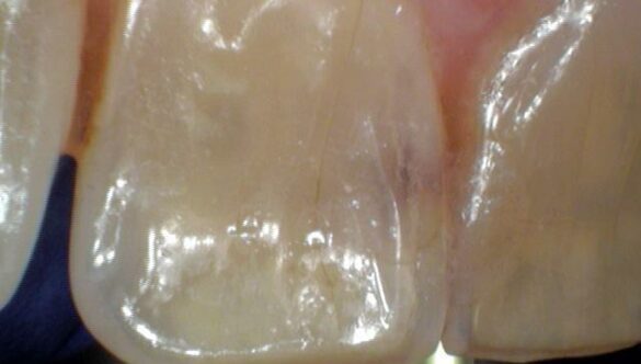 Tooth Fillings – Before/After Photos Herculite