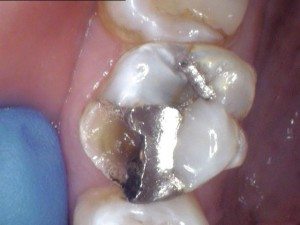 Tooth Number 14 Before The mesial buccal cusp is broken off tooth #14.