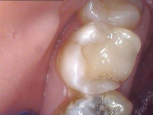 Tooth with RCT Even though #15 had a Root Canal, the crown was never done.