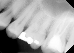 Two Crowns Needed Xray showing #14 and #15