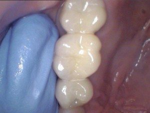Tooth #'s 13,14,15 Chewing surface of a bridge