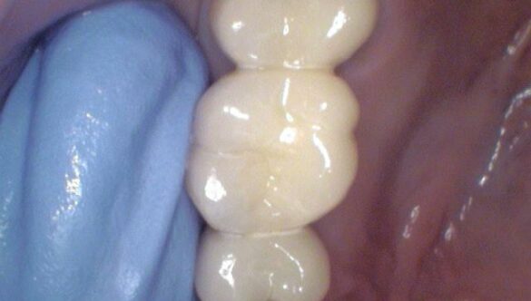 How can a fixed bridge replace a missing tooth?