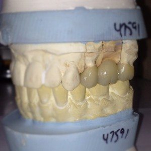 Bridge as it came back from the lab. 3 unit dental bridge, still on the models.