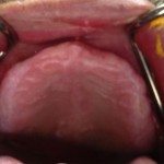 This photo shows the maxillary arch. Everything looks good. We shouldn't have any problems getting an upper denture to work here.