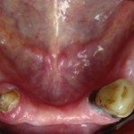Lower Mandibular arch.