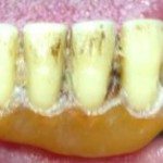 This photo shows Mike's lower partial denture in place. When I fist met Mike, I was hoping we could keep those two lower teeth. They had no mobility, would have been good anchor teeth and his lower partial denture was relatively stable. Unfortunately after looking at the X-rays, the two lower canines were unrestorable. We are making an important assumption here. Mike mentioned that he had dentures, and that he was pleased how they worked. Our overall goal is to make his new set as close as possible to his old set, as far as function.