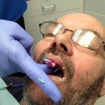 Place it in the mouth, and wait for the impression material to cure.