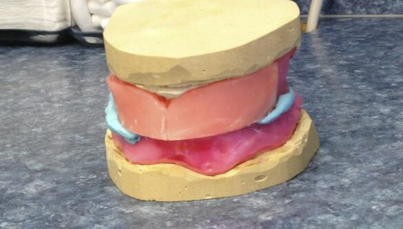 Dentures FAQ – The Third Visit