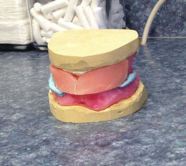 Dentures FAQ – The Third Visit