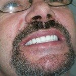 We visually check to see how the denture looks.