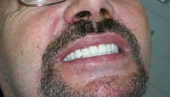 Dentures FAQ – The Fourth Visit