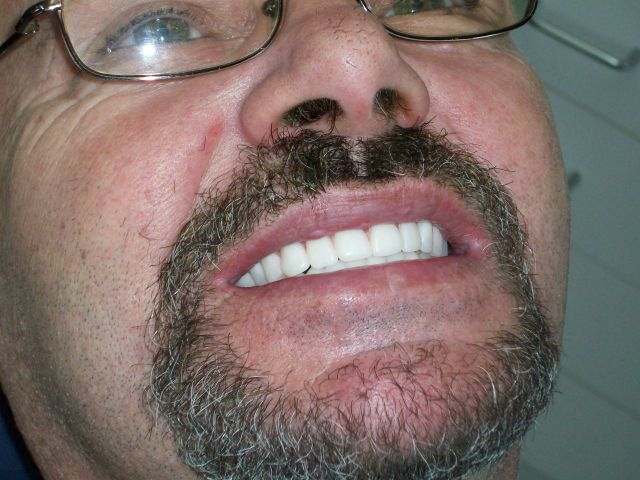 Dentures FAQ – The Fourth Visit