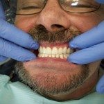 We visually check to see how the denture looks. This is an ideal overjet/overbite — looks good!