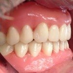 Here are the teeth, set in wax. I am a big fan of Dentsply Portrait teeth. I like the fact that they have a lot of “personality.” Sometimes pictures don’t do justice to how good they really look.