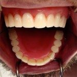 The upper wax denture in place. Normally, we don’t take all these photos, but we did it this time for educational purposes.