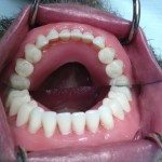 The lower wax denture in place. Note, photo is of the lower denture and the reflection in the mirror.