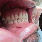 Photo from the side showing how the upper and lower teeth engage. Everything looks ideal.