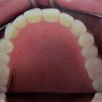 On the upper arch, we had Mike chew on articulating paper, to check on where his denture is chewing.