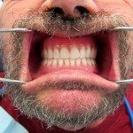 If you look real closely, you can see that tooth No. 9 has dropped a bit. I know during denture fabrication that teeth can shift in the final stages. Some of our patients like having teeth that are set irregularly because they look more like “normal” teeth, and some patients would prefer that they be set to optimal perfection. If Mike prefers, I can take a sanding disk and polish No. 9 to make the two central teeth perfectly symmetrical.