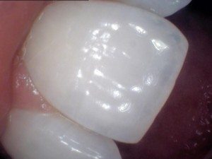 Central incisor showing translucency.