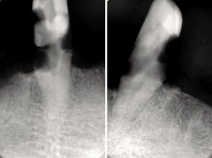 X-Rays showing teeth #'s 22,27.