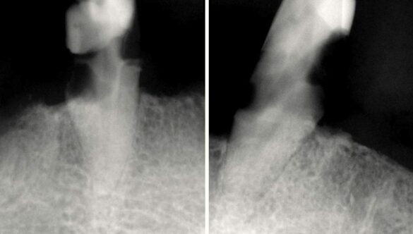 Dentures FAQ – The First Visit