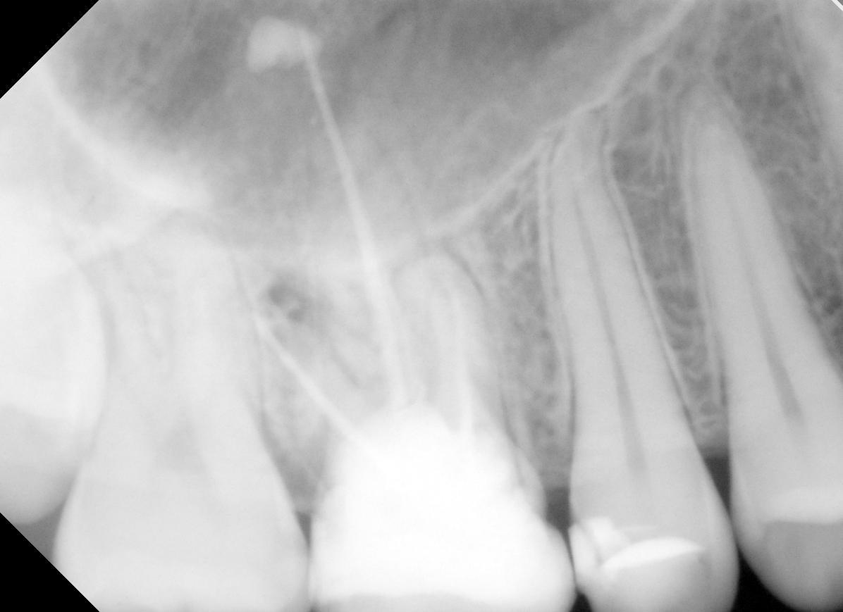 This x-ray shows tooth #3 had a root canal, with no crown.