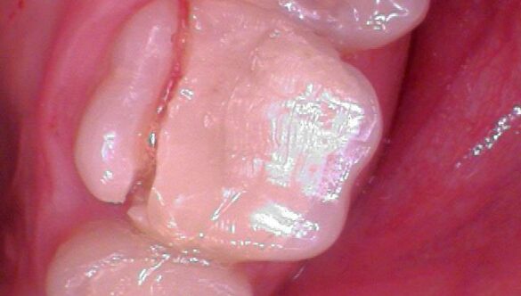 Why are crowns recommended after root canals?