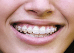 Number Of Adults Seeking Orthodontic Treatments.