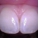 Teeth #'s 8 and 9 - Examples of teeth that have had fluoride. Frosty white appearance.