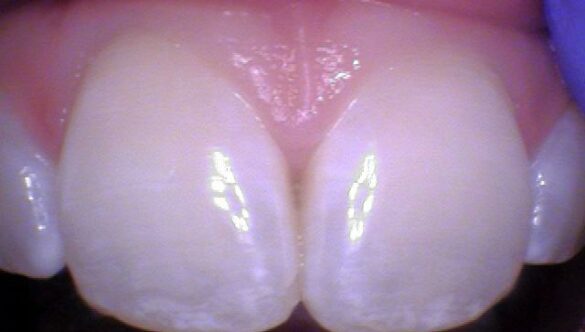 Is fluoride safe?