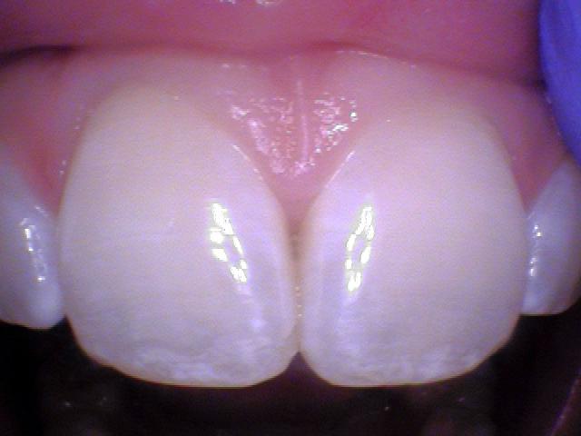 Is fluoride safe?