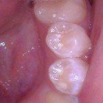 Teeth #'s 20 and 21 - Examples of teeth that have had fluoride. Frosty white appearance.