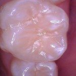 Upper 6 year molar - Examples of teeth that have had fluoride. Frosty white appearance.