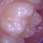 Upper 6 year molar - Examples of teeth that have had fluoride. Frosty white appearance.