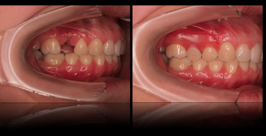 Partial Dentures Seasons Of Smiles Partial Dentures Seasons Of Smiles