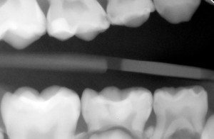 X-ray showing from a young patient with holes in his teeth.