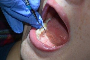 Perio - Post op Instructions