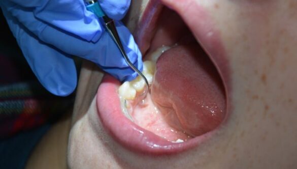 Post Operative Instructions following Periodontal Therapy