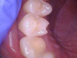 What happens when you bite down on your tongue ring