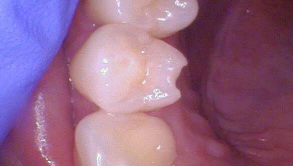 What happens when you bite down on a tongue ring