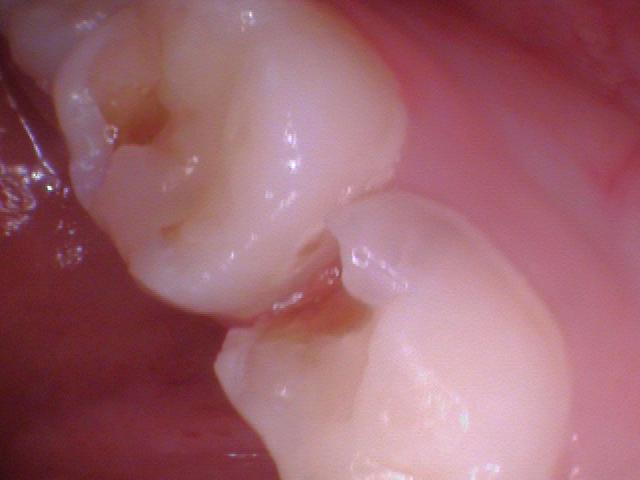 Baby teeth with holes