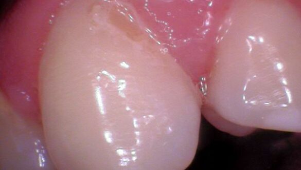 Is my saliva acidic?
