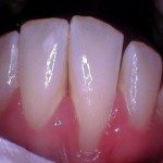 Deep Scaling and Root Planning (buccal)(after)